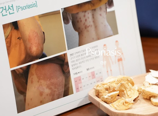 생기한의원으로 확인하는 건선 증상 의심 시 의료기관 방문 안내